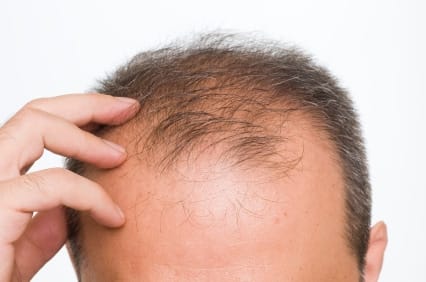 Information about balding and stem cells