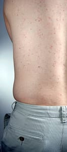 Male hormone therapy risks and acne