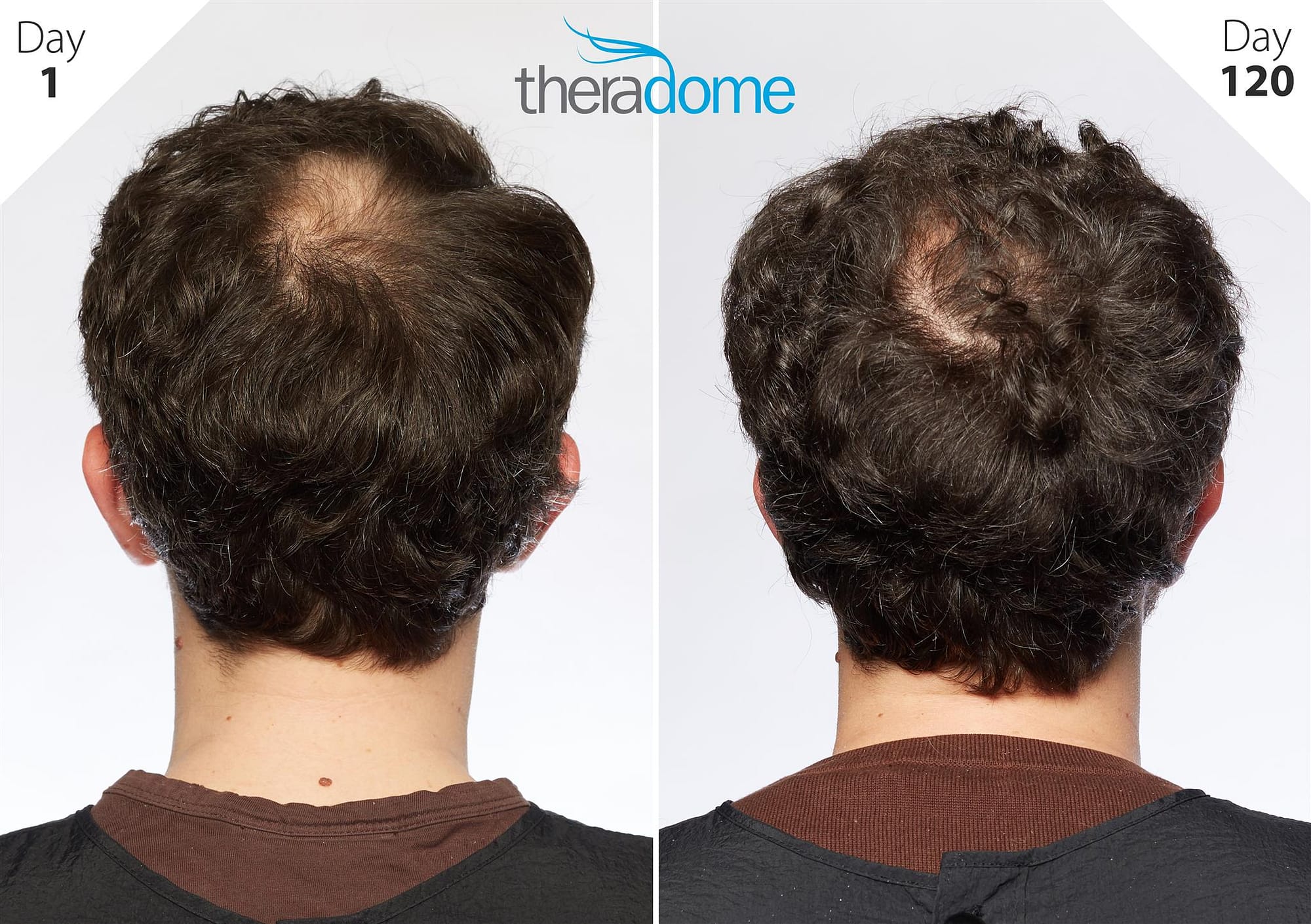 Experiencing Hair Loss? Try Theradome [Laser Therapy]