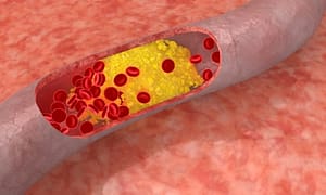 High Blood Sugar Causes Vascular Disease